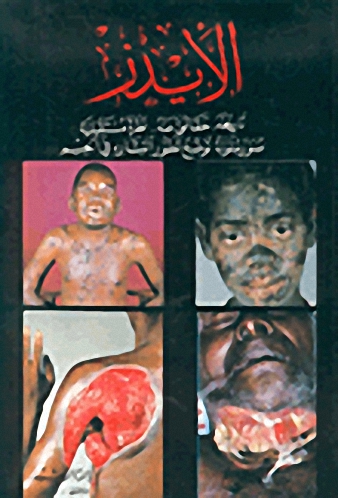 الإيدز: تاريخه - حقائق عنه - نظرة مستقبلية